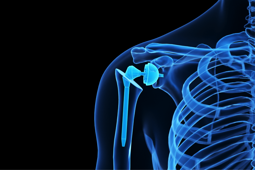 Comparison of Total Shoulder Replacement and Reverse Shoulder Replacement, showing the differences in surgical techniques and prosthetic components used to restore shoulder function and alleviate pain